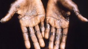 World faces big challenges over Covid, monkeypox and also wars – WHO