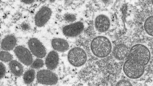 Monkeypox not presently a global health emergency: WHO