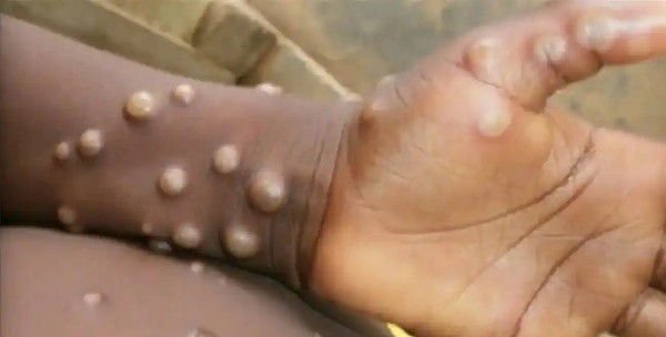 Monkeypox menace: Complete cases climb to 780, vital upgrade on fatalities and also virus spread below