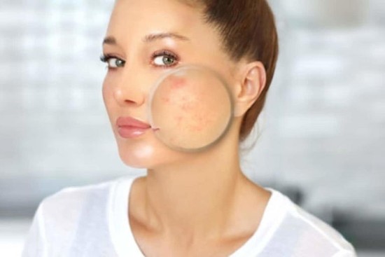 5 Home Remedies to Lighten Pokemarks On Your Face
